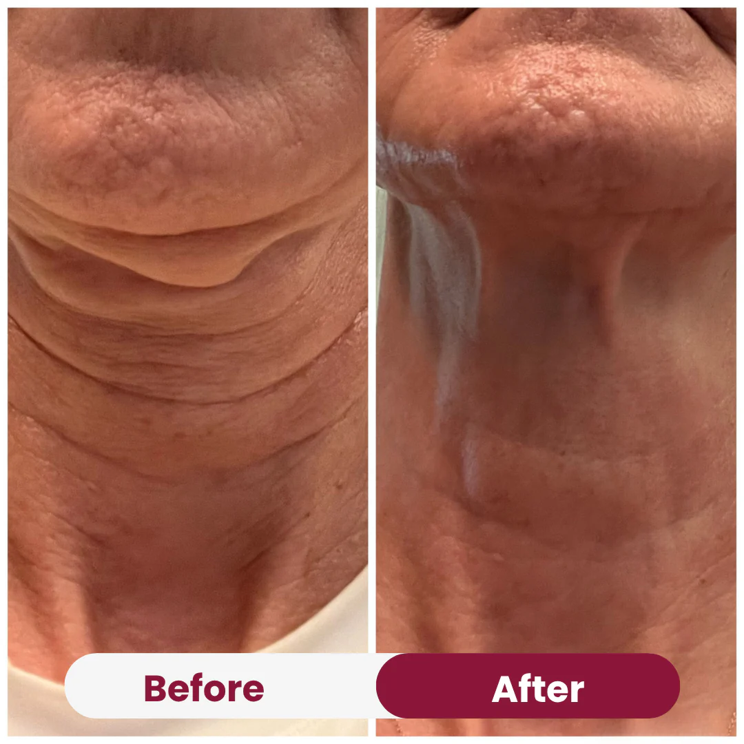Neck Anti-Wrinkle Patch - Image 6